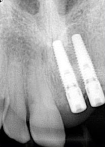 2-implants-after-removal-gr