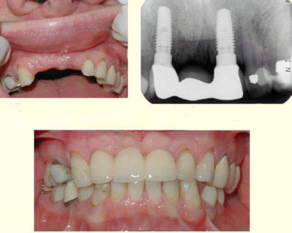 3-tooth-bridge
