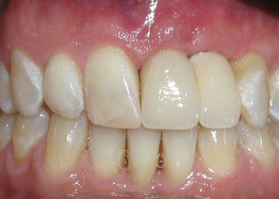 aesthetics-front-teeth-afte