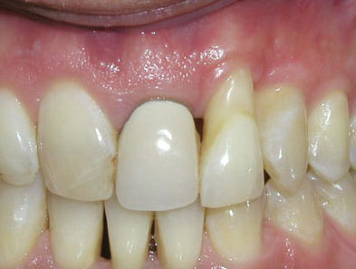 aesthetics-front-teeth-befo