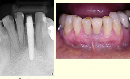 anterior_farb