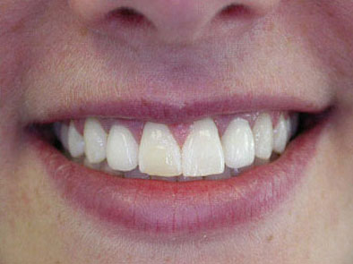 beautifully-restored-smile