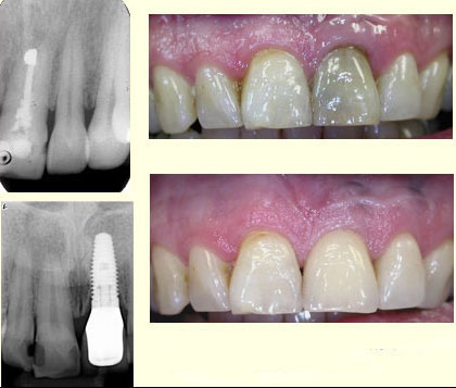 central-incisor-2