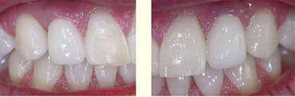 close-up-final-prosthetics