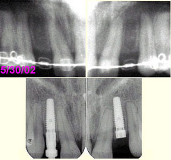 congenital-missing-lateral-