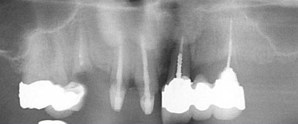 failed-anterior-prosthetics
