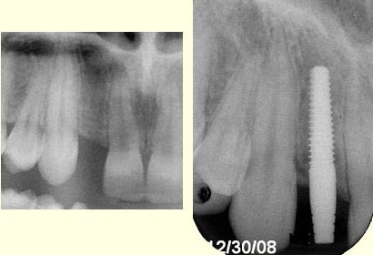 missing-maxillary