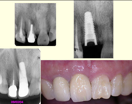 nobel-perfect-implant-syste