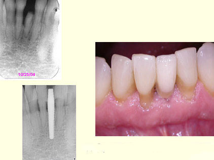 replacing-incisor-w-Nobel