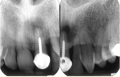 root-canal-failure-x-ray