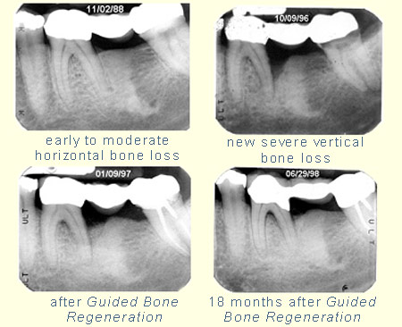 Early to severe bone loss, after Guided Bone Regeneration and 18 months after Guided Bone Regeration