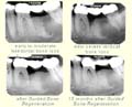 Early to severe bone loss and 18 months after Guided Bone Regeneration