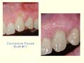 Connective Tissue Graft #11