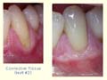 Connective Tissue Graft #22