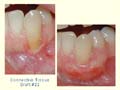 Connective Tissue Graft #22