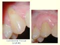 Connective Tissue Graft #6
