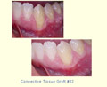 Connective Tissue Graft #22