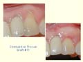 Connective Tissue Graft #11