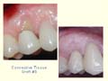 Connective Tissue Graft #5