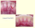 Lingual Graft #25