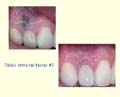 Tattoo Removal Facial #7