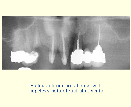 Failed anterior prosthetics with hopeless natural root abutments