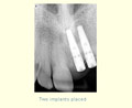 Two implants placed
