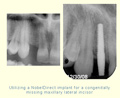 Example of a NobelDirect implant