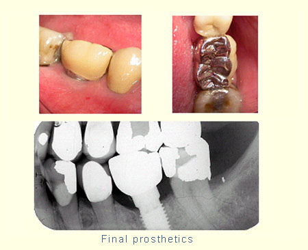 Final prosthetics