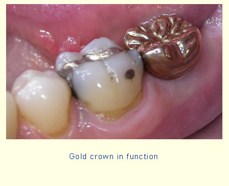 Gold crown in function