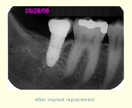 After implant replacement