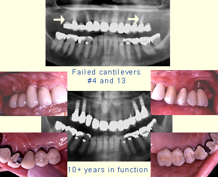 Failed cntilevers #4 and 13, 9+ years in function