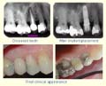 Replacing a failed root canal upper bicuspid thumbnail