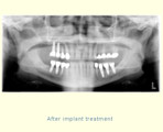 After implant treatment