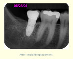 After implant replacement