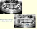 Adding molar teeth to the lower left thumbnail
