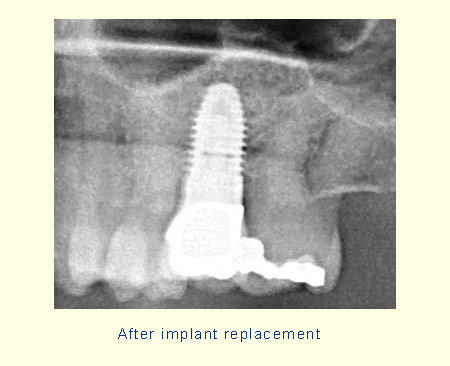 Successful tooth replacement