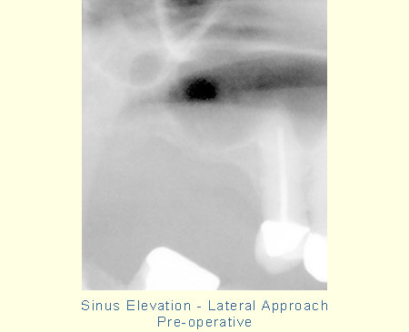 Sinus Elevation - Lateral Approach - Pre-operative
