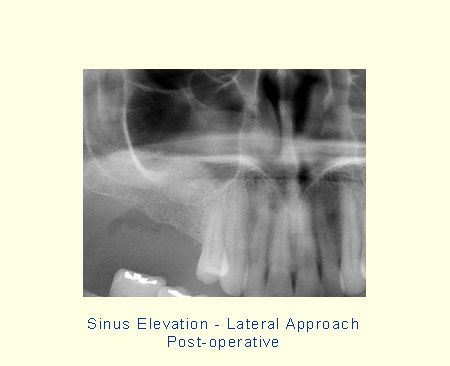 Sinus Elevation - Lateral Approach - Post-operative