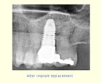 Successful tooth replacement