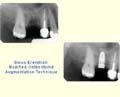 Sinus Elevation - Osteotome Technique