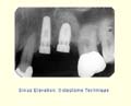 Sinus Elevation - Osteotome Technique