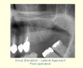 Sinus Elevation - Lateral Approach - Post-operative