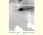 Sinus Elevation - Lateral Approach - Pre-operative