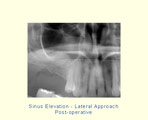 Sinus Elevation - Lateral Approach