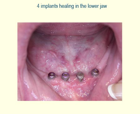 Full Arch Case Study