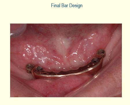 Full Arch Case Study