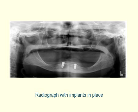Full Arch Case Study