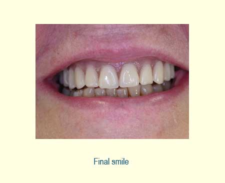 Full Arch Case Study