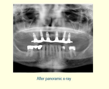 Full Arch Case Study